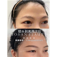 博妍额头剥离填充一般要多少钱