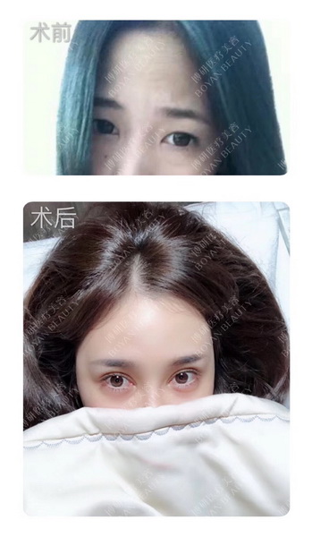 广州博研双眼皮方案怎么选择 