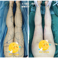 腿不直整形需要多少钱