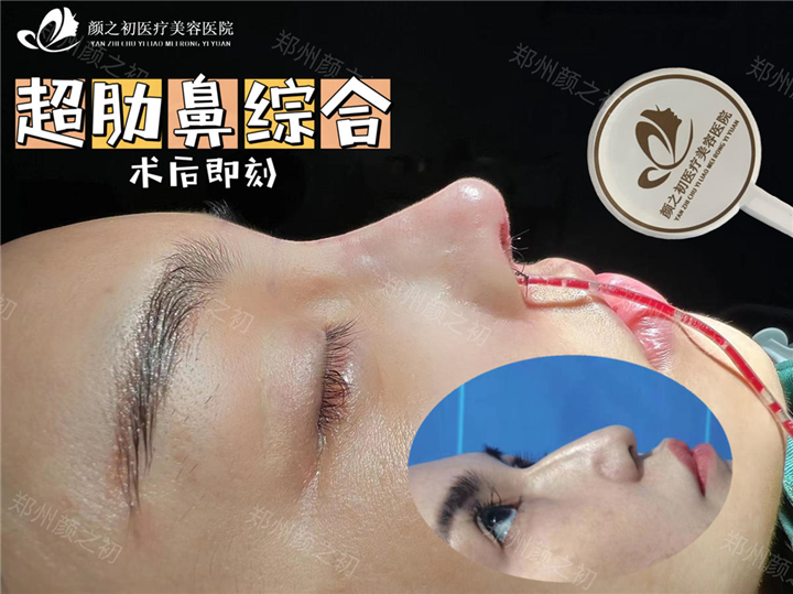 郑州超肋鼻综合整形