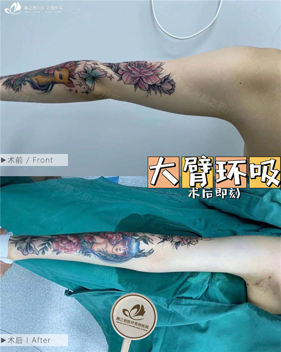 郑州大臂环吸整形