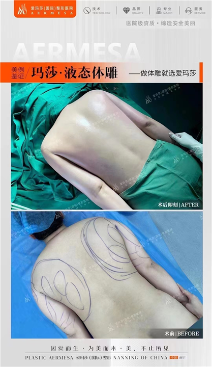 南宁脂雕医生