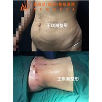 南宁脂雕整形医生