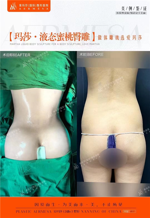 王琪海医生脂雕效果好吗