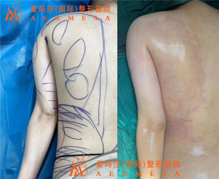 背部吸脂+手臂吸脂