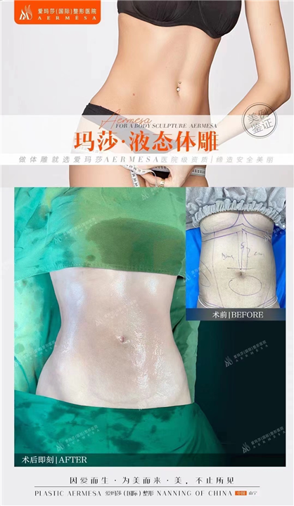 王琪海抽脂怎么样