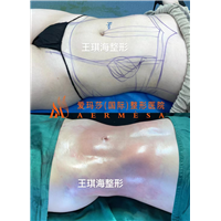 王琪海医生小基数吸脂