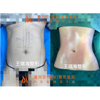 王琪海医生小基数腰线