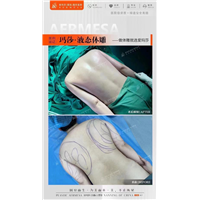 王琪海背部吸脂