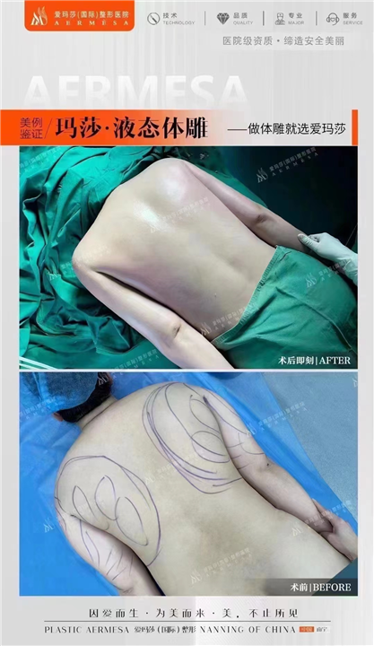 王琪海背部吸脂