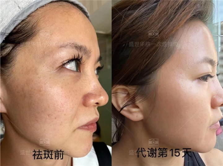 盛世华肤：不做“斑女郎”，秋季祛斑正当时