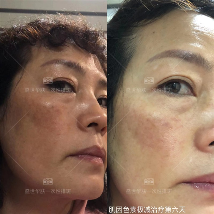盛世华肤肌因色素极减治疗第六天