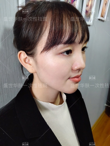 长沙祛斑
