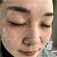 盛世华肤祛斑