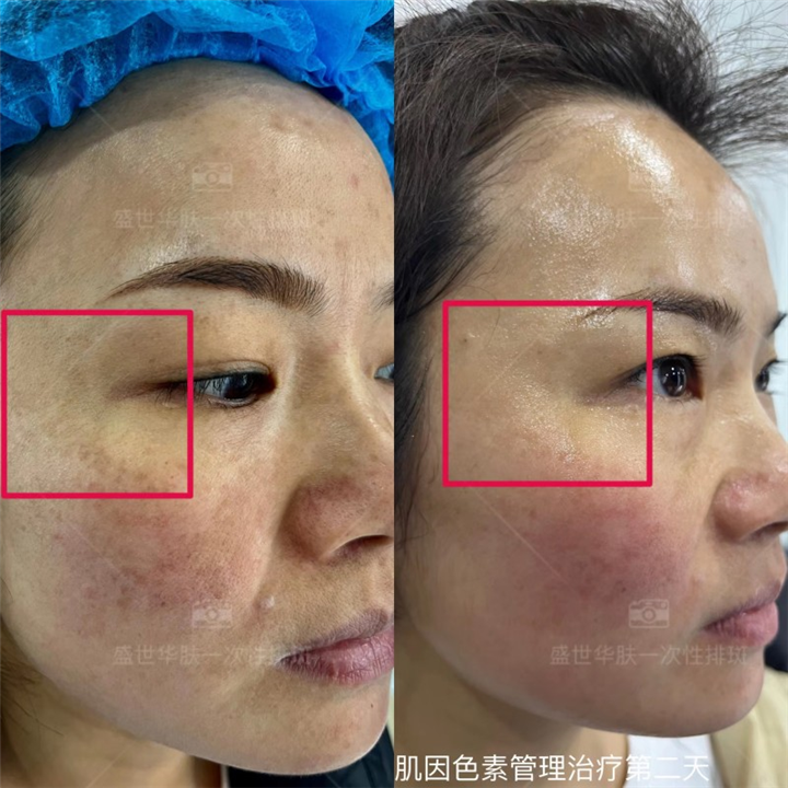 肌因色素管理治疗第二天
