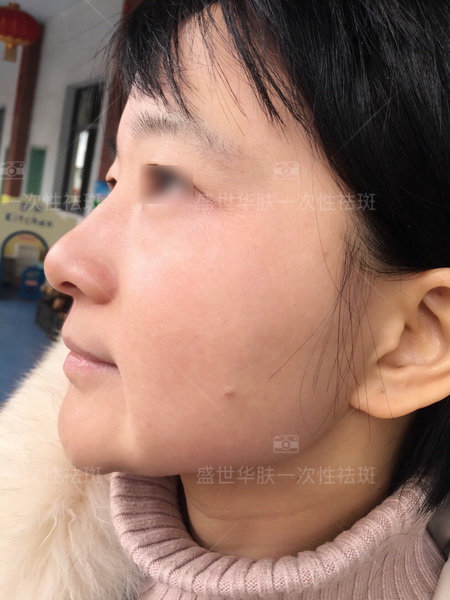 盛世华肤研发核心色斑溶解代谢酶技术