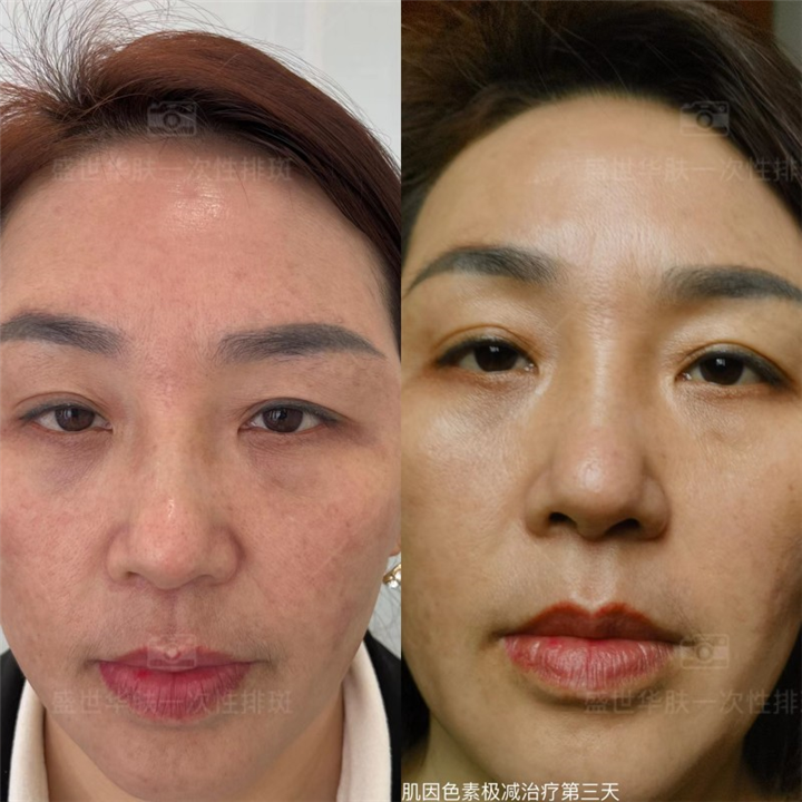 盛世华肤肌因色素极减治疗第三天