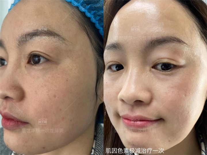 盛世华肤肌因色素极减治疗一次