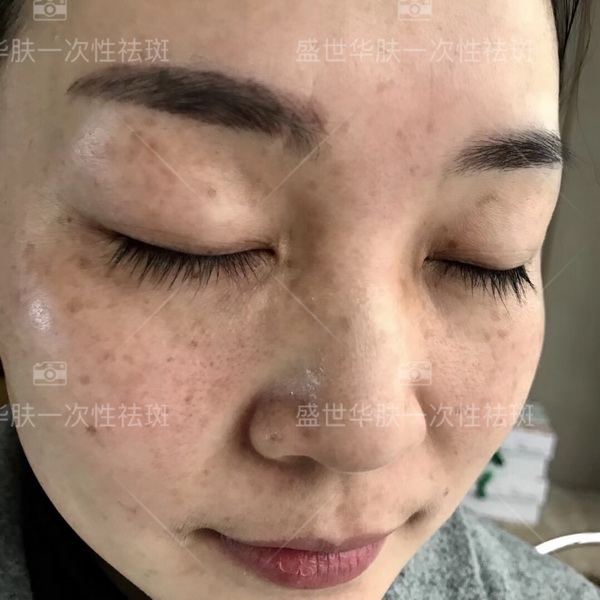 盛世华肤祛斑