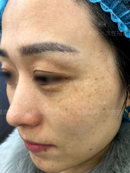 盛世华肤祛斑靠谱吗？