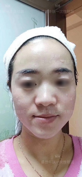 盛世华肤祛斑