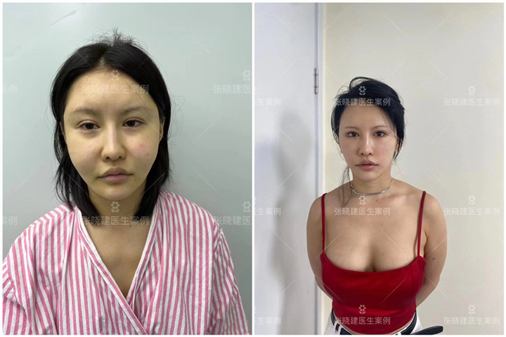 面部异物取出专家张晓建打造