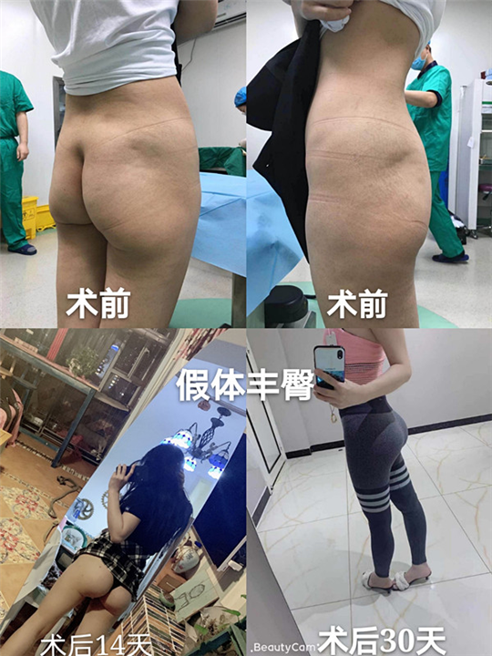 河东镐下颌角整形