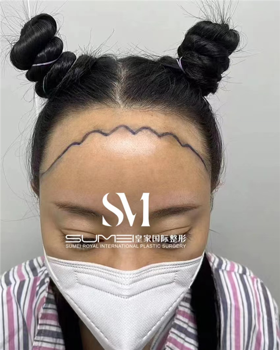柬埔寨整形哪家好