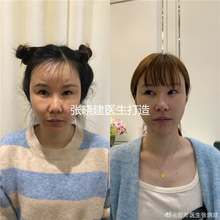 面部小切口拉皮专家