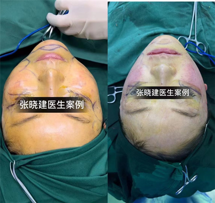 浙江做拉皮手术的专家