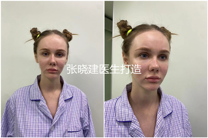 面部小切口拉皮专家