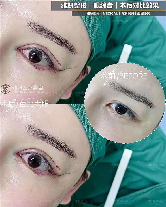 广州眼综合整形价格
