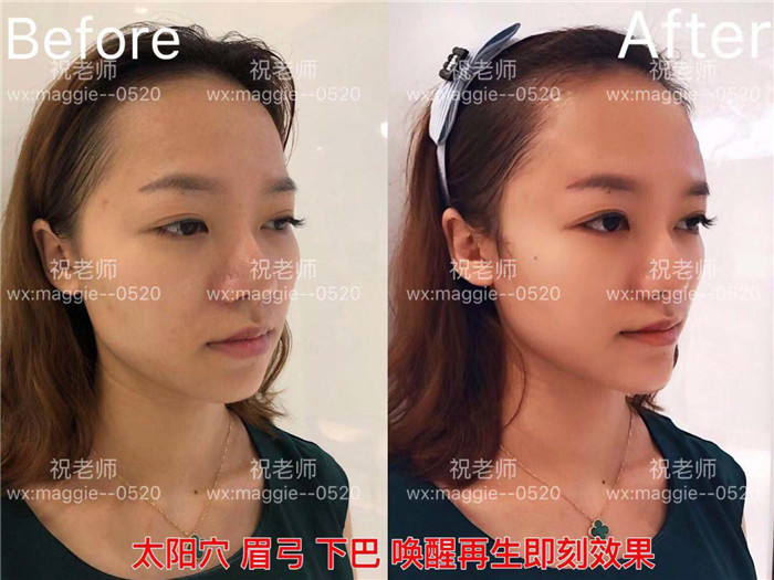 贵阳剥离微整