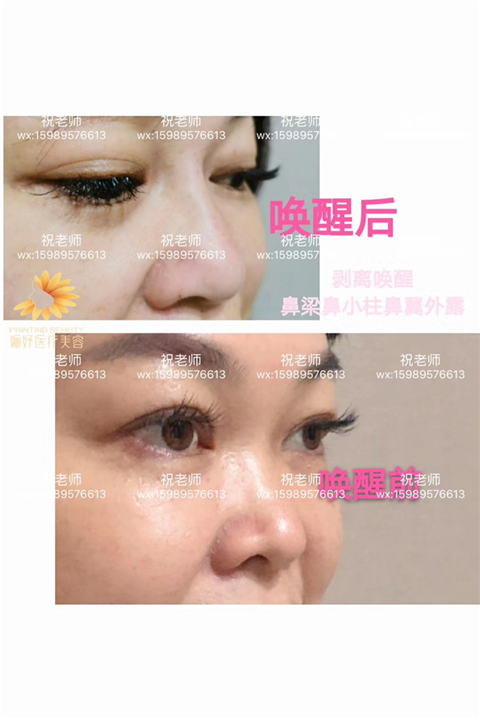剥离鼻子
