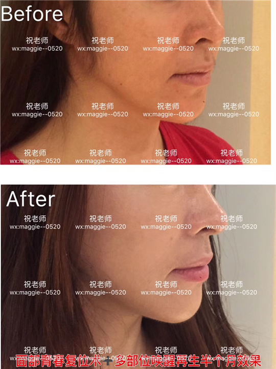 印第安纹韧带剥离手术