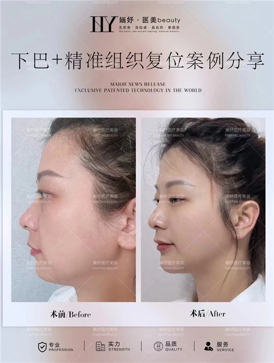 成都剥离抗衰