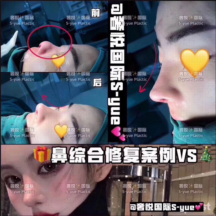 奢悦国际鼻综合
