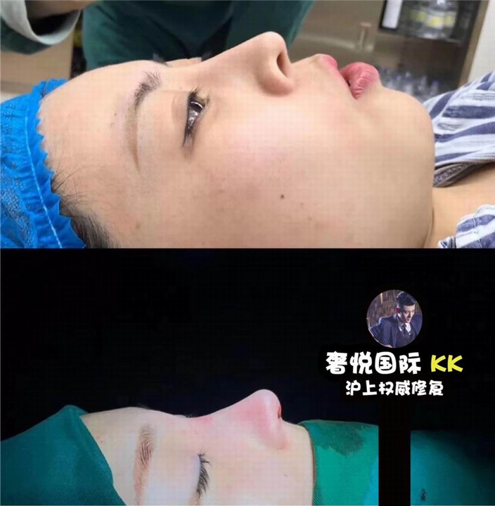 奢悦国际鼻综合