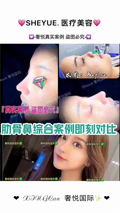 奢悦国际鼻综合