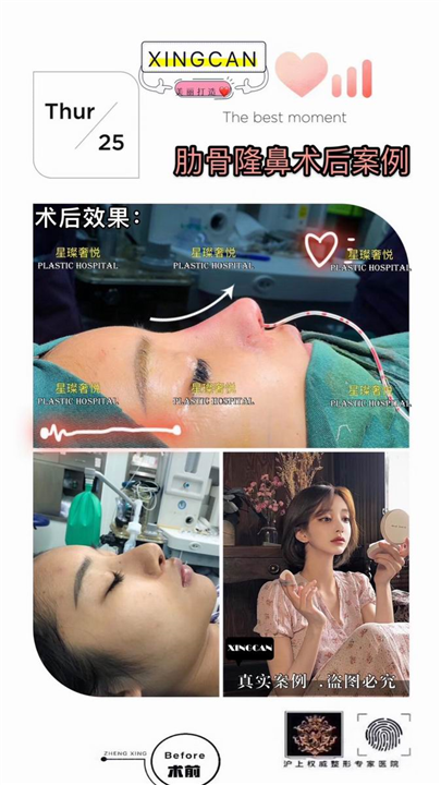 奢悦国际鼻综合