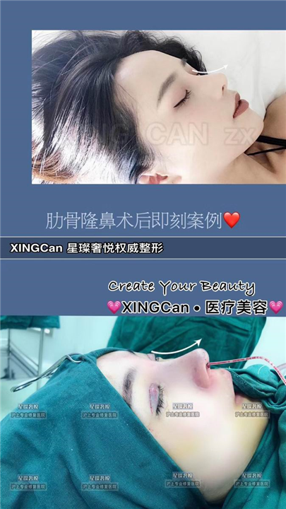 奢悦国际鼻综合