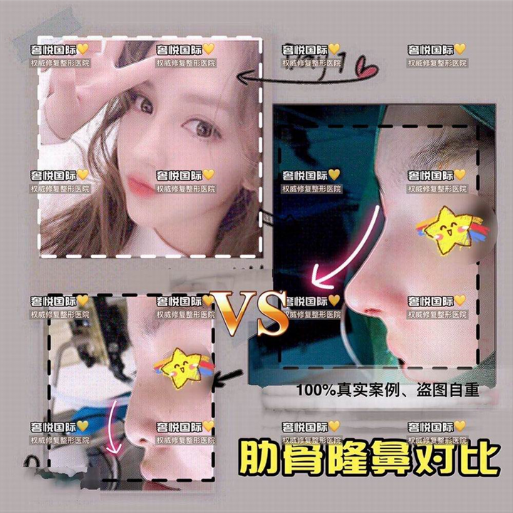 奢悦国际鼻综合