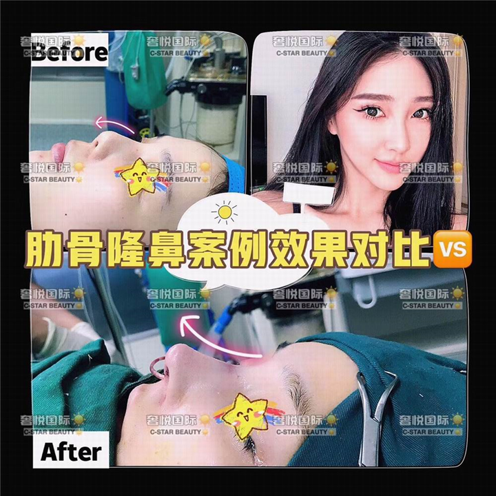 奢悦国际鼻综合