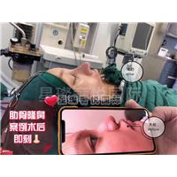 奢悦国际鼻综合