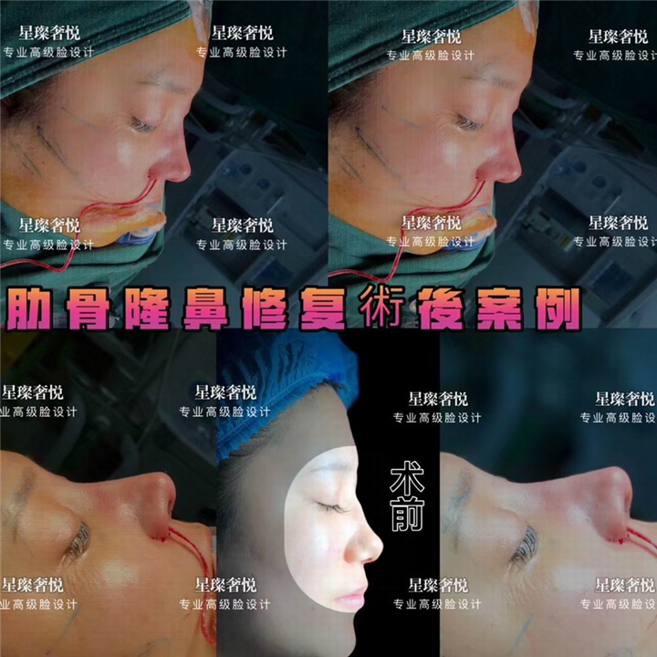 奢悦国际鼻综合