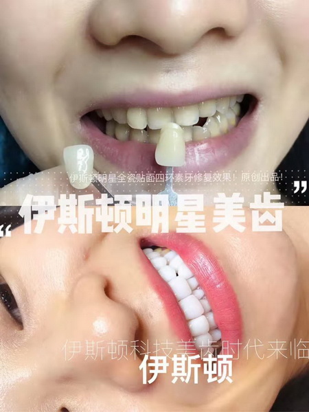 伊斯顿牙齿美白总部
