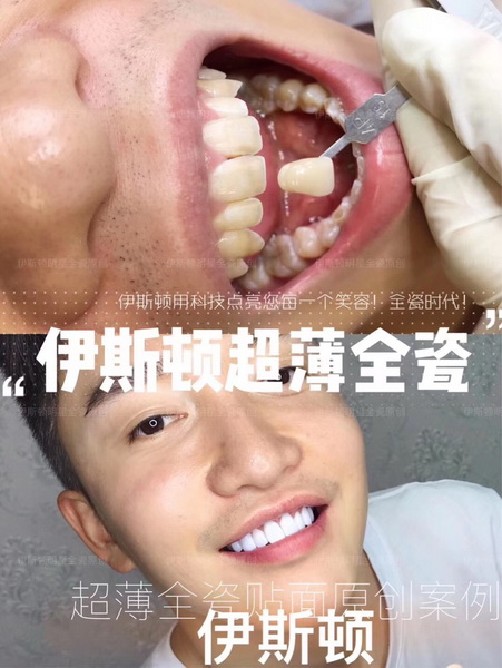 伊斯顿美牙