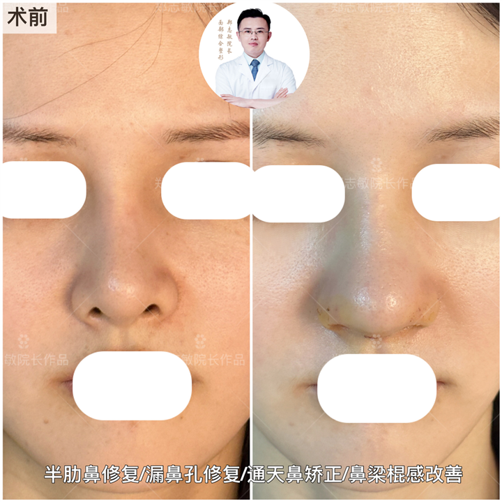郑志敏医生修复半肋隆鼻案例