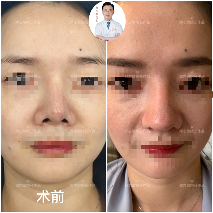 肋软骨隆鼻修复手术后1个月对比