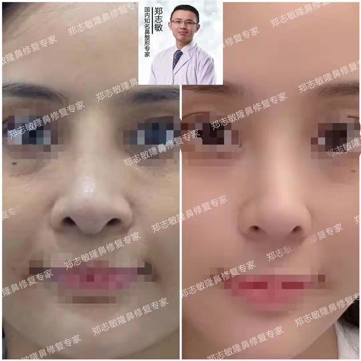 全肋鼻修复案例 